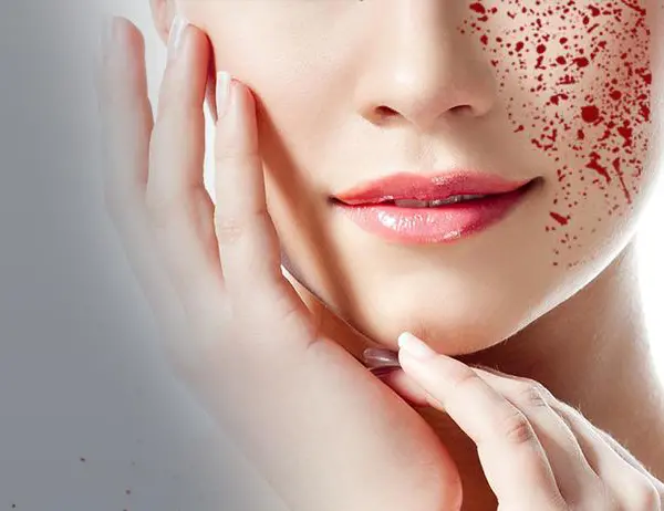 ¿“Facial Vampiro”? Tratamiento de belleza vinculado al contagio de VIH