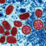 La viruela símica regresa: ¿de qué se trata este mal?