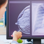 Con inmunoterapia se curan más pacientes de cáncer de mama triple negativo, según estudio