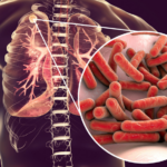 La tuberculosis supera el covid-19 y vuelve a ser la enfermedad infecciosa más mortal