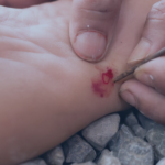 Tétanos bajo vigilancia en RD: Salud Pública reporta 28 casos sospechosos