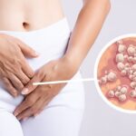 Estudio revela que de cada cinco personas entre 15 y 49 años padece herpes genital