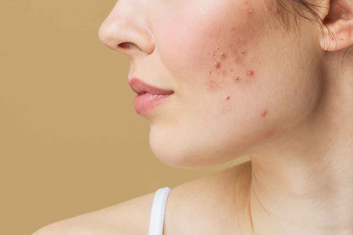 Estrés empeora las alergias cutáneas, según investigadores
