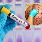 La OMS y UNICEF advierten que el sarampión en Europa está a su nivel máximo en 25 años