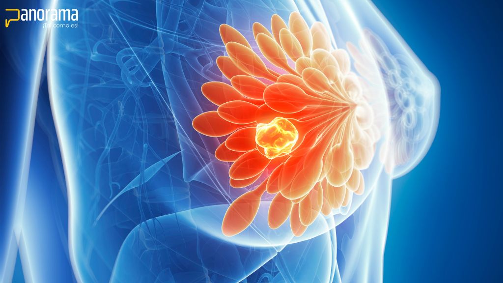 cáncer de mama