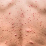 Aseguran viruela del mono sigue siendo emergencia de salud y preocupación internacional