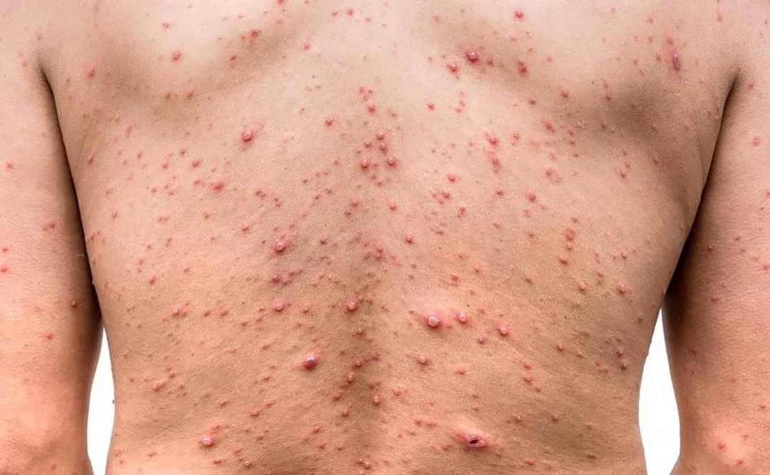 Aseguran viruela del mono sigue siendo emergencia de salud y preocupación internacional