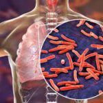 Tuberculosis