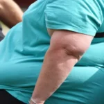 Especialistas piden nombrar la obesidad como una “enfermedad crónica”