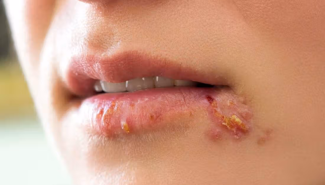 Cómo tratar el herpes labial con estos 7 remedios naturales