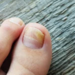 Cómo eliminar hongos de las uñas de los pies de manera natural