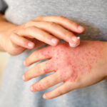 Advierten sobre aparición de brotes de dermatitis causados por el verano