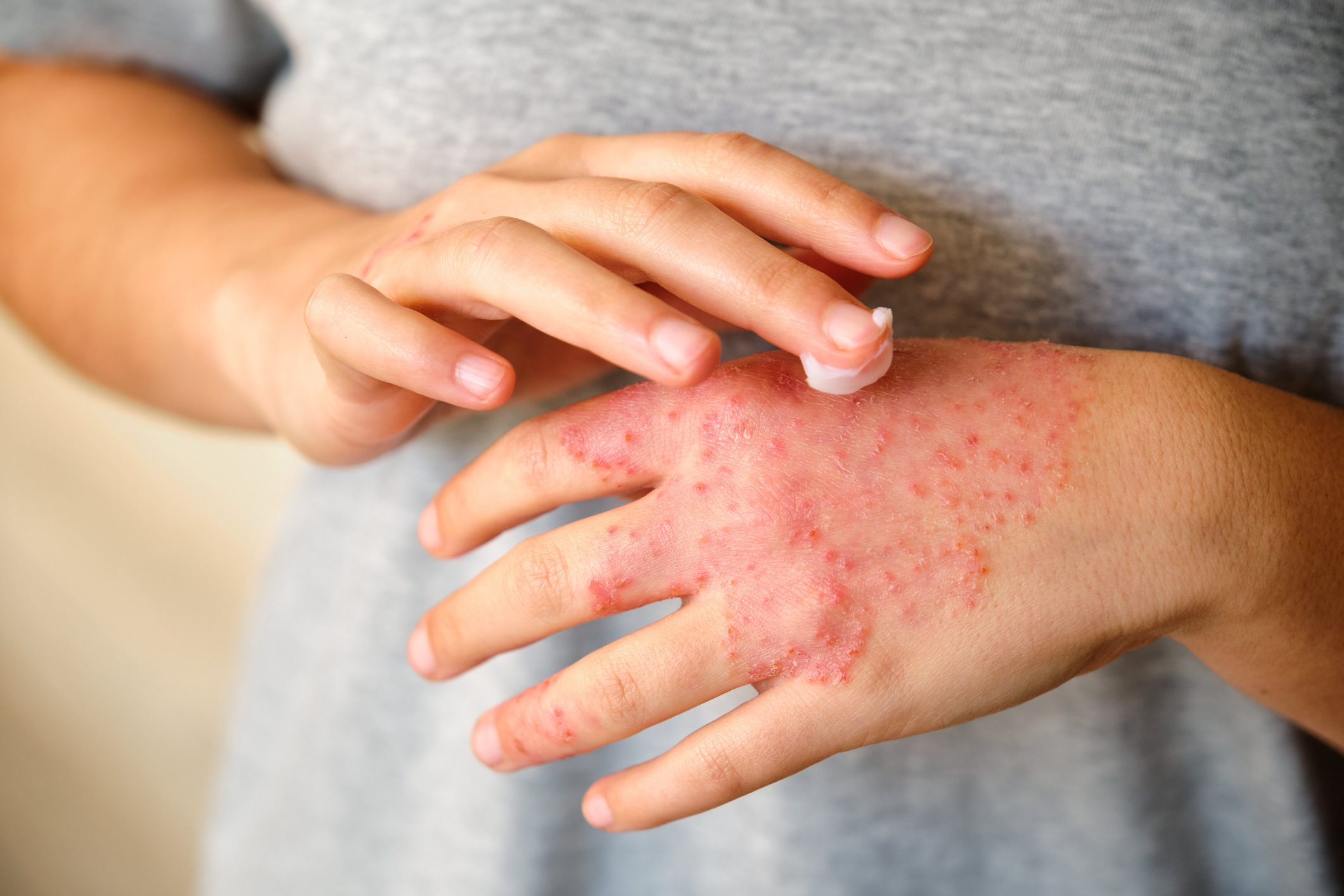 Advierten sobre aparición de brotes de dermatitis causados por el verano