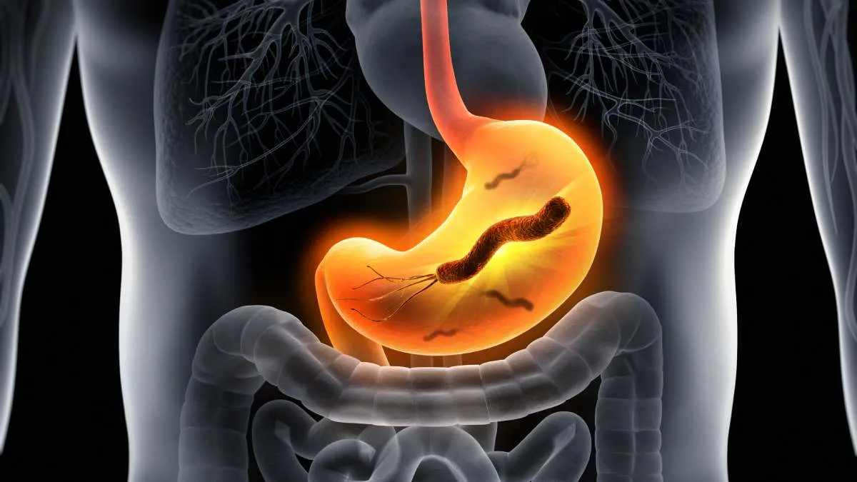 Expertos advierten que bacteria Helicobacter pylori multiplica el riesgo de cáncer