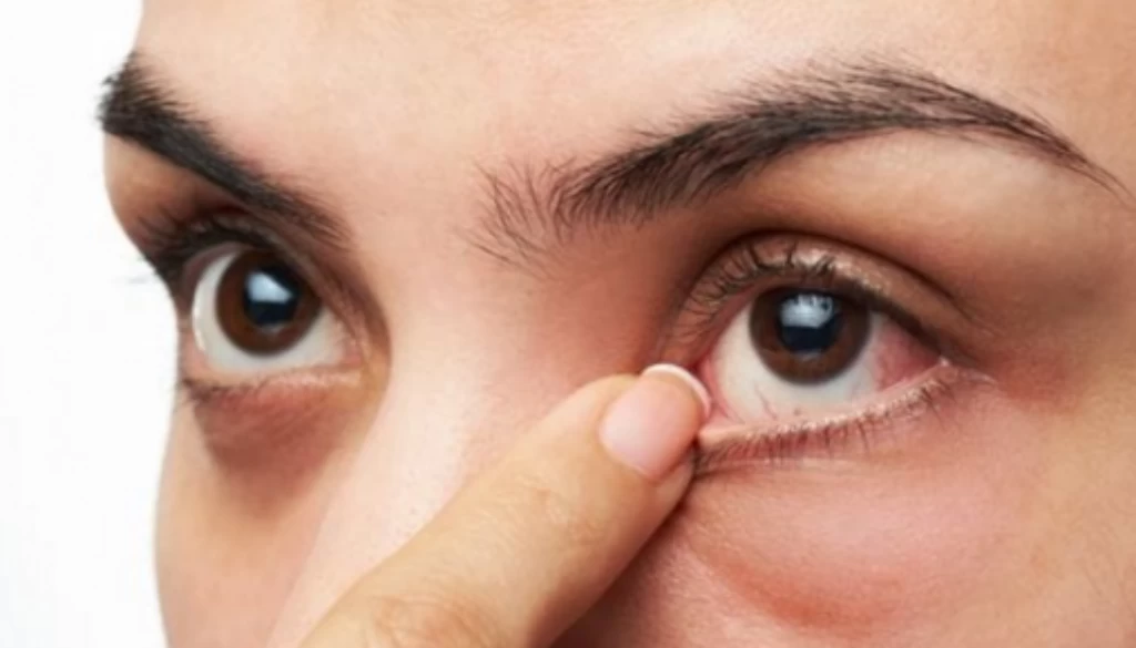 Síndrome del ojo seco / Fuente externa