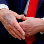 USA se cuestiona salud de Trump, tras descubrírsele un hematoma pese a capa de maquillaje