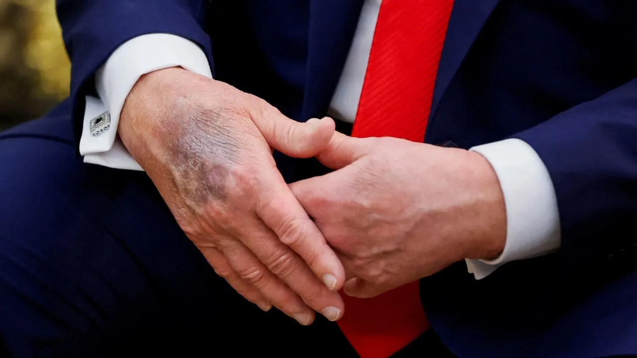USA se cuestiona salud de Trump, tras descubrírsele un hematoma pese a capa de maquillaje