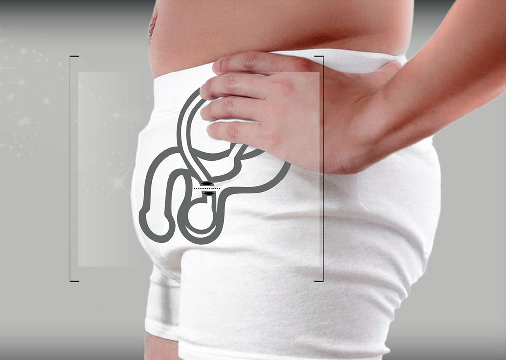 En que consiste vasectomía o esterilización masculina  