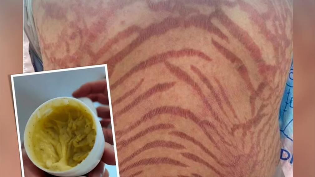 La paciente de 40 años, fue identificada con el seudónimo de Tingting