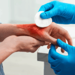 Demandan área de atención médica para quemados en Santiago