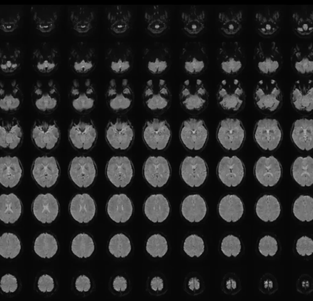 La resonancia magnética funcional (fMRI) es una técnica no invasiva que mide la actividad cerebral. Esta imagen de fMRI muestra múltiples vistas horizontales del cerebro, dispuestas de abajo hacia arriba. 