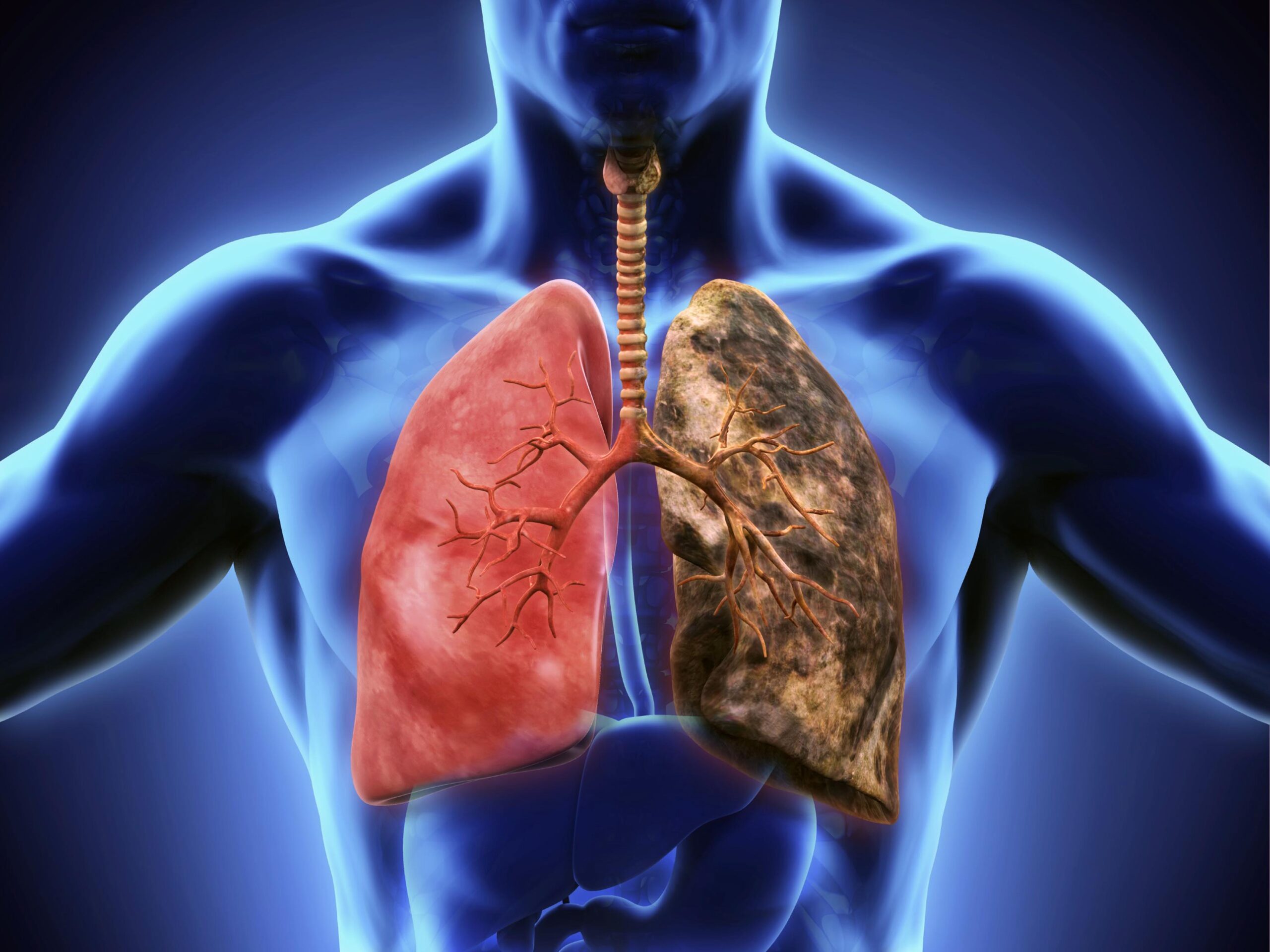 Cáncer de pulmón