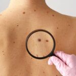 5 señales para detectar un lunar peligroso y prevenir el cáncer de piel
