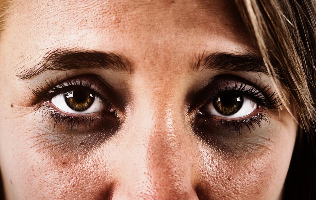 Cómo reducir ojeras y bolsas y cuándo son una señal de alarma, según expertos